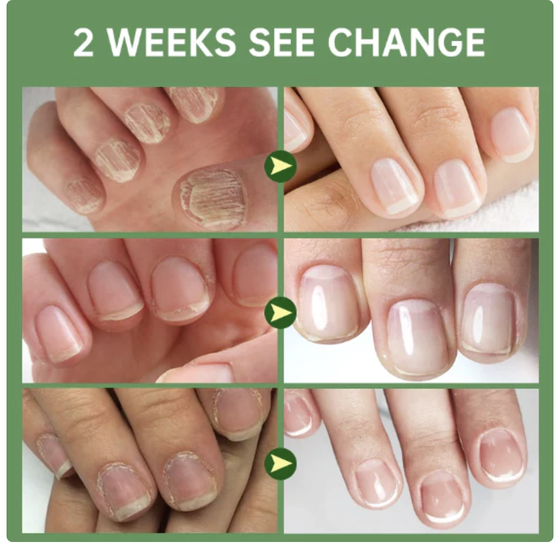 Endurecedor de uñas 4K potente crecimiento & hongos0(COMPRA 1 Y LLEVAS 3 EN TOTAL)⭐⭐⭐⭐⭐,‼️(ENVIO GRATIS 🔥)PAGO CONTRA ENTREGA🚛. - mega-store-colombi