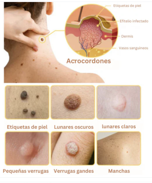 Tag Recede Eliminador de verrugas-OBSEQUIO CREMA ACLARANTE⭐⭐⭐⭐⭐,,(ENVIO GRATIS 🔥)PAGO CONTRA ENTREGA🚛