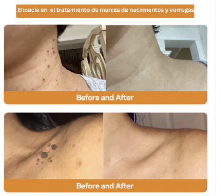 Tag Recede Eliminador de verrugas-OBSEQUIO CREMA ACLARANTE⭐⭐⭐⭐⭐,,(ENVIO GRATIS 🔥)PAGO CONTRA ENTREGA🚛